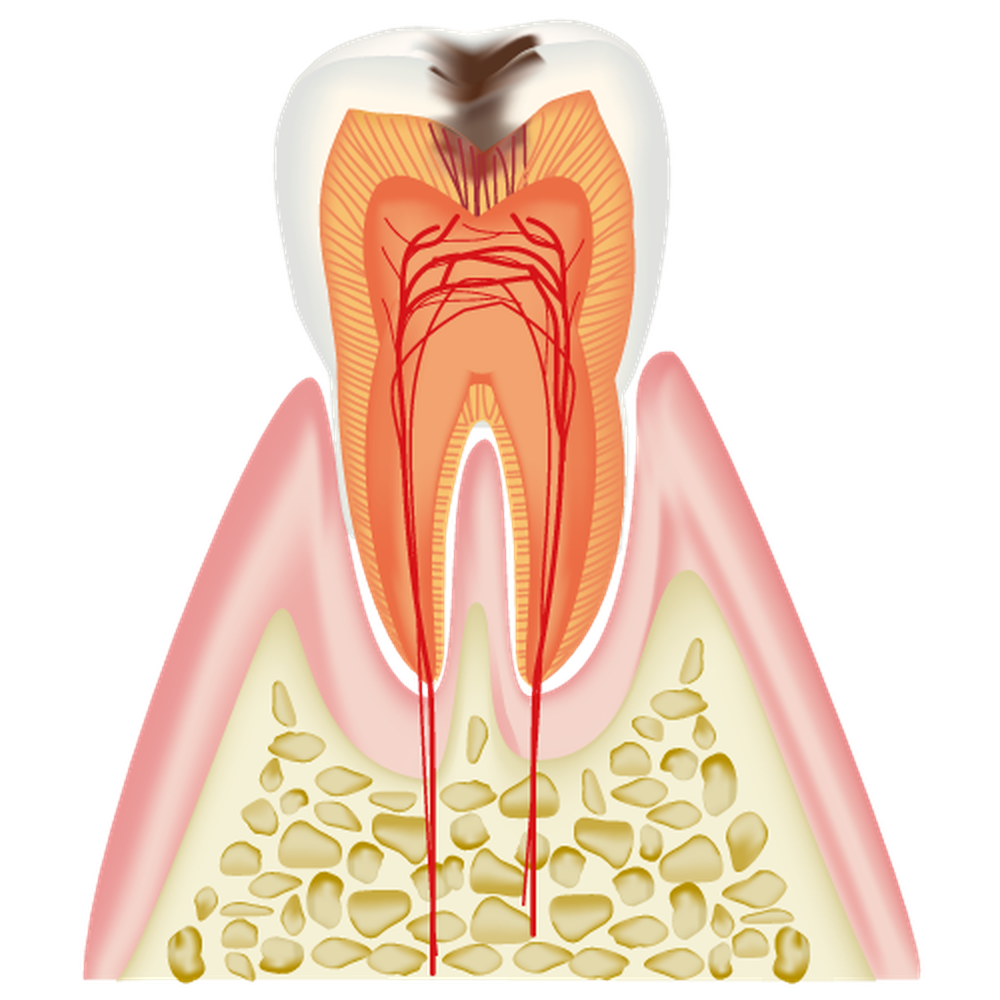 象牙質のむし歯（C2）