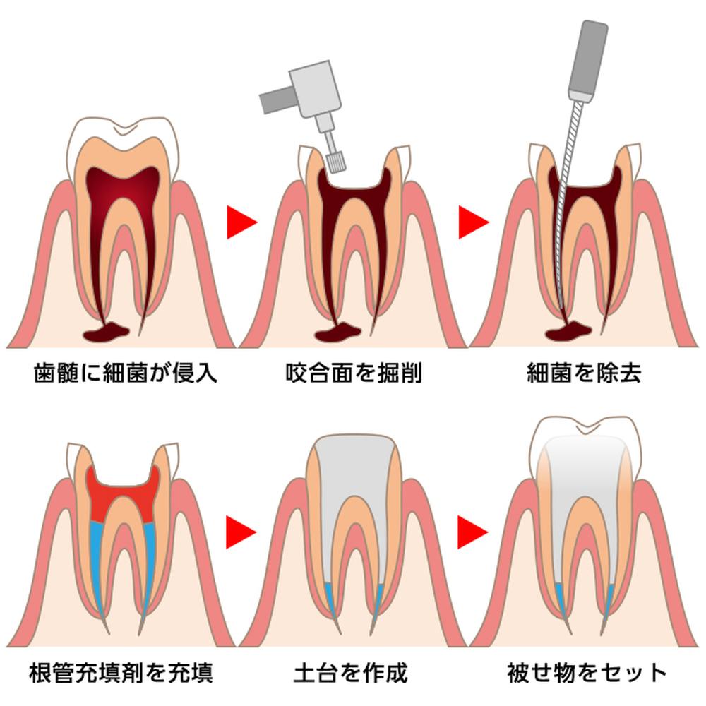 可能な限り歯を残す「根管治療」