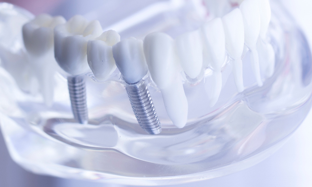 インプラント治療