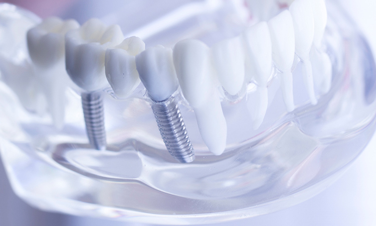 インプラント治療